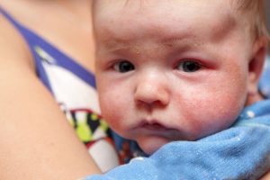 아기의 피부 발진에 대처하는 방법