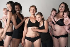 튼살을 없애는 5가지 방법