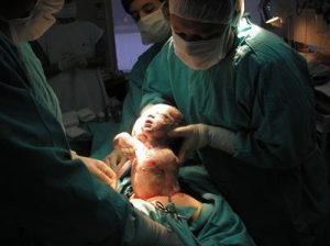 제왕 절개에 관한 핵심 내용 3가지
