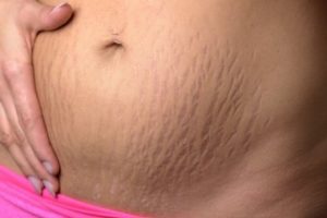 임신부 튼살을 어떻게 관리해야 할까?