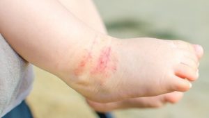 아이의 아토피성 피부염에 대처하는 15가지 팁