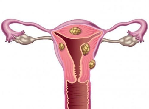 자궁근종의 원인, 증상 및 불임과의 관계