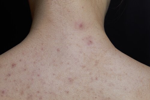 아이의 성홍열에 대한 정보