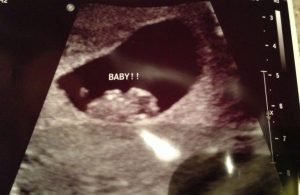 태아의 성별을 알 수 있는 램지법