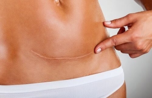 제왕절개 수술 자국을 치유하는 방법