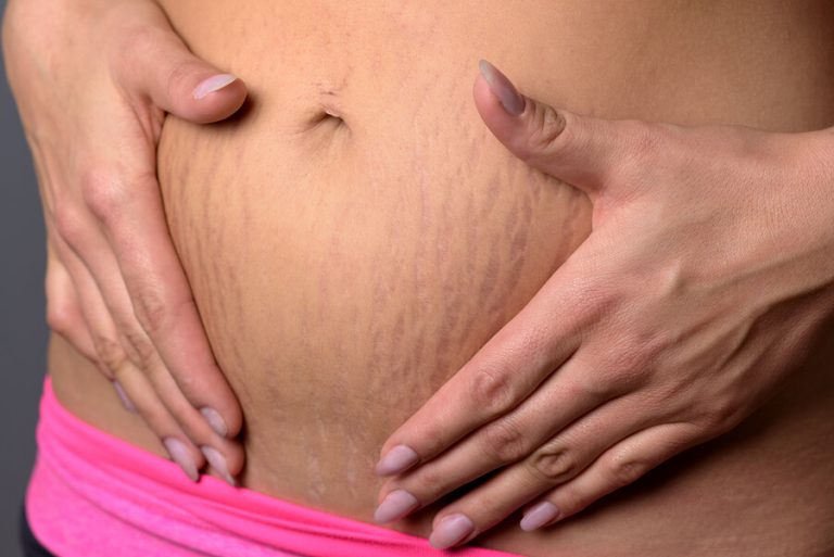 임신으로 생긴 튼살 자국을 없애는 방법