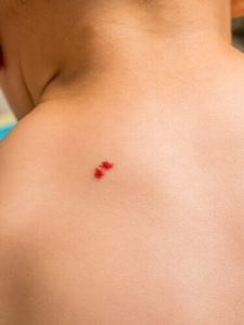 아이에게 혈관종이 있다면 어떻게 해야 할까?