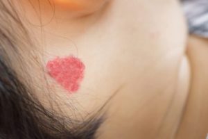 소아 혈관종의 치료 아이에게 혈관종이 있다면 어떻게 해야 할까?