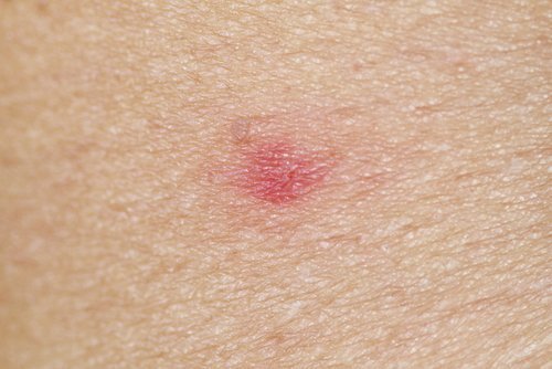 말벌에 쏘이면 어떻게 해야 할까?