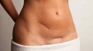 흉터 자국을 완화하고 치료하는 최고의 방법