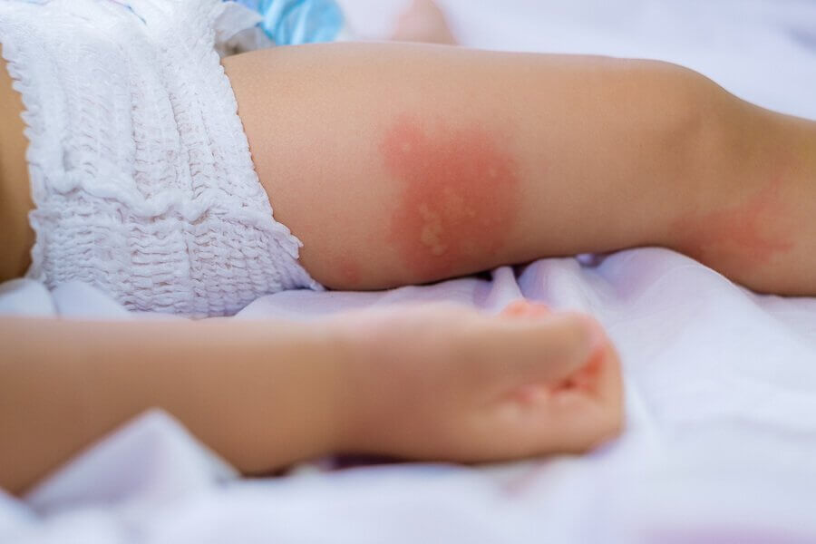 기저귀 발진을 예방하고 치료하는 방법