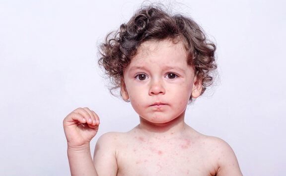 땀 알레르기가 있는 아이의 증상 및 치료