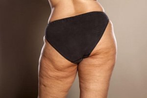 셀룰라이트를 어떻게 없앨까?