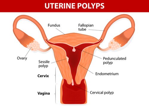 자궁 내막 폴립의 진단 