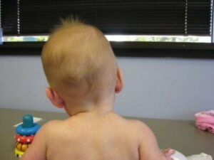 아동 척추측만증에 대해 알아야 할 모든 것