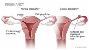 자궁 외 임신의 원인, 증상 및 치료