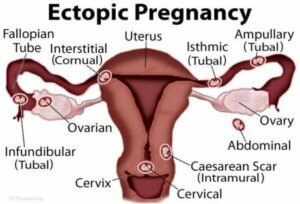 자궁 외 임신의 원인, 증상 및 치료