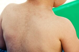 다모증 또는 어린이의 과도한 모발 성장은 무엇일까?