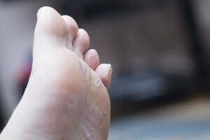 소아 발바닥 피부염의 원인은 무엇일까?