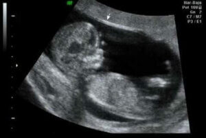 임신 12주 차의 초음파