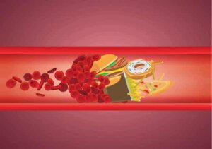 어린이의 높은 콜레스테롤: 원인과 치료법